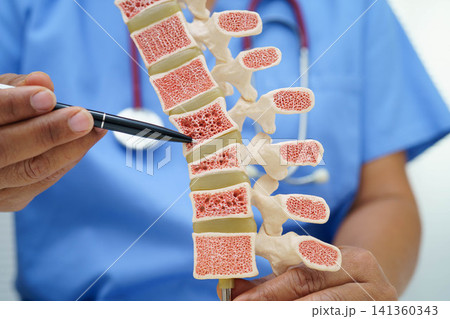 Doctor holding osteoporosis in back bone model for treatment medical in orthopedic department. Doctor holding osteoporosis in back bone model for treatment medical in orthopedic department. 141360343