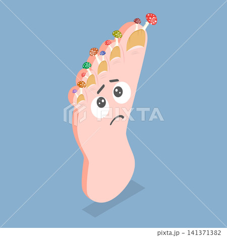 3D Isometric Flat Vector Illustration of Nail Issue, Fungal Infection Of The Nails 141371382