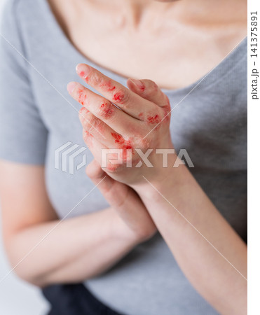 手荒れする女性（特殊メイク） 141375891