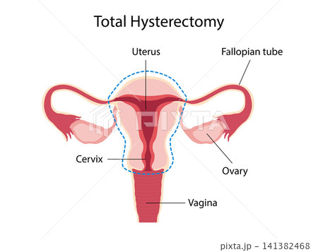 Total hysterectomy. Female reproductive anatomy. Gynecological surgery diagram for anatomy education, medical, healthcare presentations, clinical resources. Vector Medical educational illustration Total hysterectomy. Female reproductive anatomy. Gynecological surgery diagram for anatomy education, medical, healthcare presentations, clinical resources. Vector Medical educational illustration 141382468