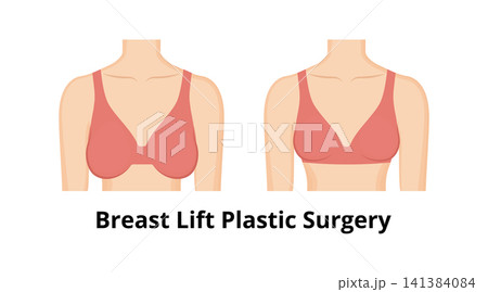 Breast lift plastic surgery procedure comparing results Breast lift plastic surgery procedure comparing results 141384084