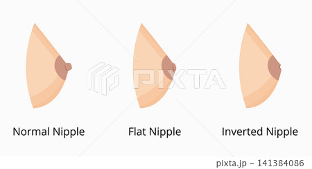 Different nipple types illustrating normal, flat, and inverted anatomy Different nipple types illustrating normal, flat, and inverted anatomy 141384086