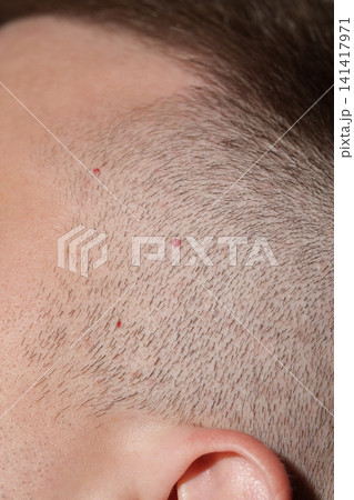 Red cherry angiomas on a man scalp near the hairline, close-up. Red cherry angiomas on a man scalp near the hairline, close-up. 141417971