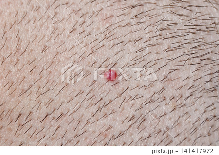 A cherry angioma on the scalp of a man with a short haircut. Close-up. A cherry angioma on the scalp of a man with a short haircut. Close-up. 141417972