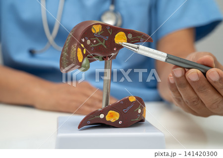 Cirrhosis, Liver cancer, fatty liver, Asian doctor with liver human anatomy model in World Hepatitis Day at hospital. Cirrhosis, Liver cancer, fatty liver, Asian doctor with liver human anatomy model in World Hepatitis Day at hospital. 141420300