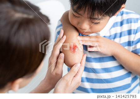 腕に擦り傷の怪我をする子供と手当てする母親・特殊メイク 141425793