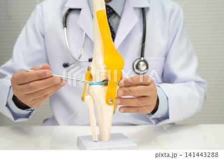 Osteoarthritis of the knee, Doctor holding human knee joint orthopedic anatomy model in hospital. Osteoarthritis of the knee, Doctor holding human knee joint orthopedic anatomy model in hospital. 141443288