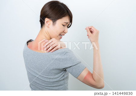 赤く日焼けする女性 赤く日焼けする女性 141449830