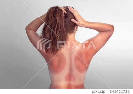 Woman back skin irritation from sun exposure needs care. Summer heat causes redness and discomfort. Swimsuit skin marks. White skin under a swimsuit Woman back skin irritation from sun exposure needs care. Summer heat causes redness and discomfort. Swimsuit skin marks. White skin under a swimsuit 141461723