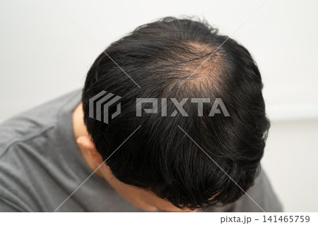 Bald in the middle head and begin no loss hair glabrous of mature Asian business smart active office man. Bald in the middle head and begin no loss hair glabrous of mature Asian business smart active office man. 141465759