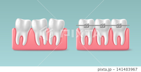 Professional dental braces on 3D teeth model 141483967