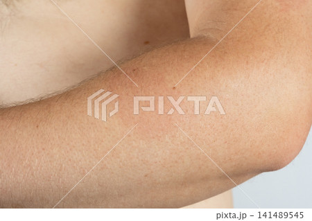 Medical symptom of Lyme disease with characteristic red ring rash on human body 141489545