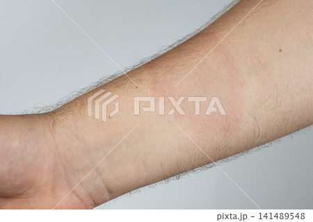 Medical symptom of Lyme disease with characteristic red ring rash on human body Medical symptom of Lyme disease with characteristic red ring rash on human body 141489548