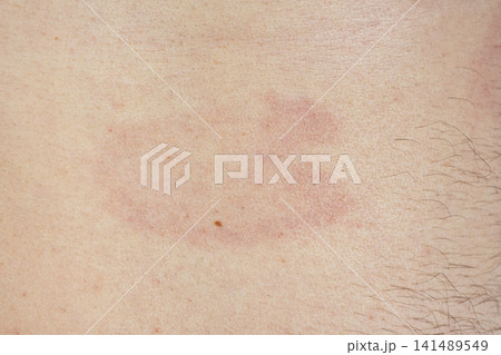 Erythema migrans rash on human skin caused by Lyme disease from a tick bite Erythema migrans rash on human skin caused by Lyme disease from a tick bite 141489549