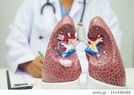 Pneumonia, lung cancer, Asian doctor with human lung model. Pneumonia, lung cancer, Asian doctor with human lung model. 141496098