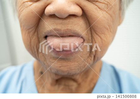 Cysts at the tongue in mouth of Asian elderly old lady woman patient. Cysts at the tongue in mouth of Asian elderly old lady woman patient. 141500808