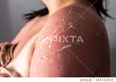 Woman with peeling skin on shoulders after sunburn. Red irritated patches from UV overexposure. Reminder to apply SPF cream and avoid peak sun hours for safety Woman with peeling skin on shoulders after sunburn. Red irritated patches from UV overexposure. Reminder to apply SPF cream and avoid peak sun hours for safety 141512024