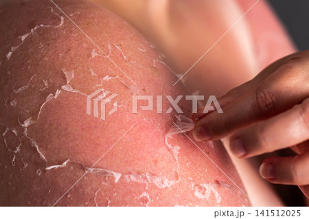 Woman removing old peeling skin after sunburn. UV damage and unprotected tanning consequences visible. Burn recovery process Woman removing old peeling skin after sunburn. UV damage and unprotected tanning consequences visible. Burn recovery process 141512025