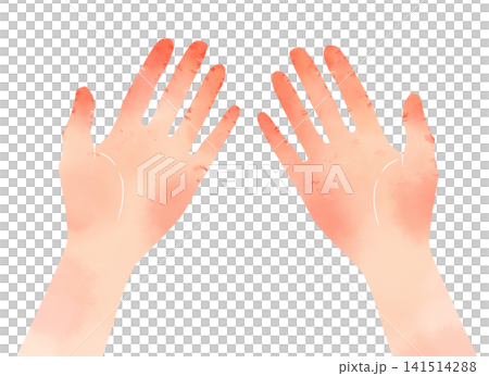 Watercolor-style illustration of chapped palms; depicting skin symptoms such as cracking and chilblains. Watercolor-style illustration of chapped palms; depicting skin symptoms such as cracking and chilblains. 141514288