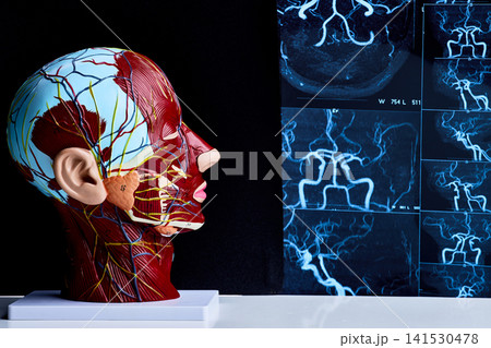 Human head anatomical model with brain angiography scan in medical clinic. Neurology and diagnostic imaging Human head anatomical model with brain angiography scan in medical clinic. Neurology and diagnostic imaging 141530478
