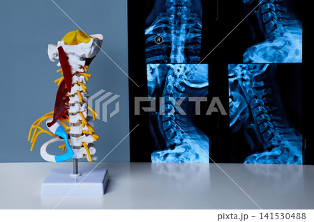 Cervical vertebrae model on doctor desk with X-ray images. Spine exam and patient consultation Cervical vertebrae model on doctor desk with X-ray images. Spine exam and patient consultation 141530488