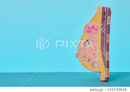 Female breast cancer anatomical model close-up. Pathology of malignant tumors for oncology check-up. 141530638