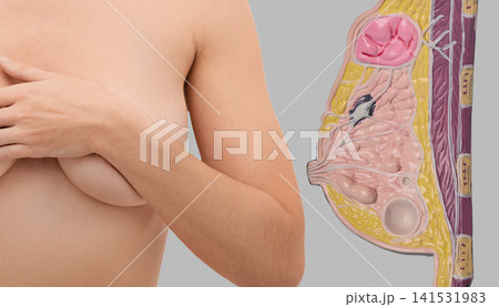 Woman performing breast self-examination next to anatomical mammary gland model. Prevention and early diagnostics of breast cancer. Woman performing breast self-examination next to anatomical mammary gland model. Prevention and early diagnostics of breast cancer. 141531983