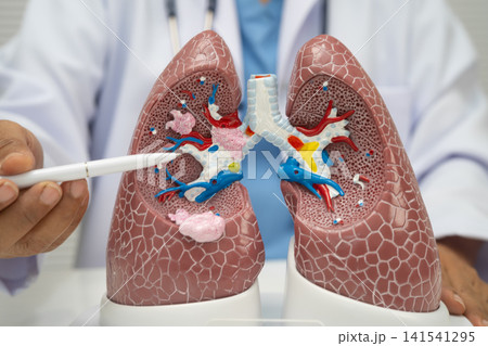 Pneumonia, lung cancer, Asian doctor with human lung model. Pneumonia, lung cancer, Asian doctor with human lung model. 141541295