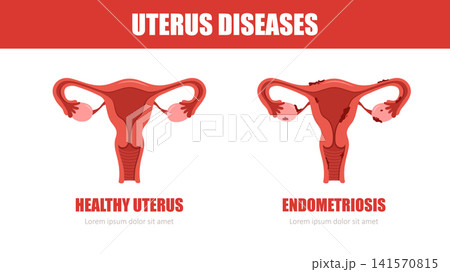 Uterus diseases. Endometriosis concept. Medical check up. Vector illustration in flat style Uterus diseases. Endometriosis concept. Medical check up. Vector illustration in flat style 141570815