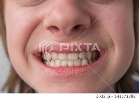Young person smiling broadly, showing perfectly aligned teeth fitted with clear invisible aligners for modern orthodontic treatment and confident oral care progress Young person smiling broadly, showing perfectly aligned teeth fitted with clear invisible aligners for modern orthodontic treatment and confident oral care progress 141571398
