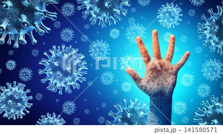 Measles Disease Outbreak Measles Disease Outbreak 141580571