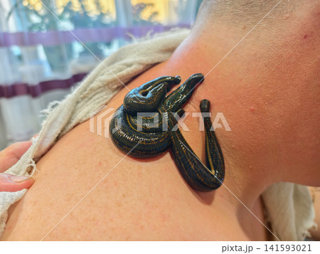 Medicinal leeches attaching to a person's neck for a natural hirudotherapy treatment, using a traditional alternative medicine approach for health and wellness. Medicinal leeches attaching to a person's neck for a natural hirudotherapy treatment, using a traditional alternative medicine approach for health and wellness. 141593021