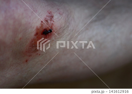 Healing wound on the leg. Healing wound on the leg. 141612916