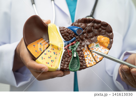 Cirrhosis, Liver cancer, fatty liver, Asian doctor with liver human model. 141613030