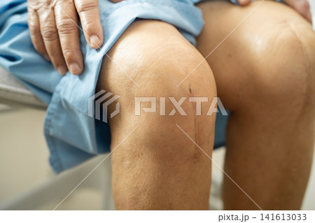 Asian elderly woman patient show her scars surgical total knee joint replacement Suture wound surgery arthroplasty on bed in hospital. Asian elderly woman patient show her scars surgical total knee joint replacement Suture wound surgery arthroplasty on bed in hospital. 141613033