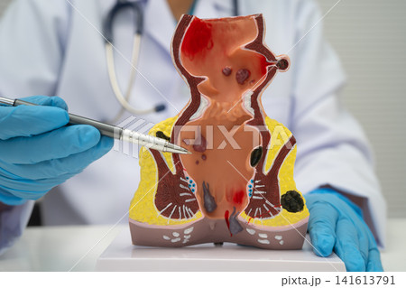 Asian doctor with rectum and hemorrhoid human model, inflamed vascular structure. 141613791