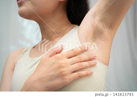 Asian woman have problem black armpit beauty skin care. Asian woman have problem black armpit beauty skin care. 141613793