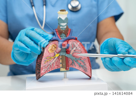 Cirrhosis, Liver cancer, fatty liver, Asian woman with liver human anatomy model. Cirrhosis, Liver cancer, fatty liver, Asian woman with liver human anatomy model. 141614084