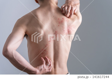 背中に発疹のある男性・特殊メイク 背中に発疹のある男性・特殊メイク 141617244