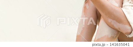 Close up of female legs and arms with vitiligo, unique pigmentation, autoimmune skin condition, copy space Close up of female legs and arms with vitiligo, unique pigmentation, autoimmune skin condition, copy space 141635041