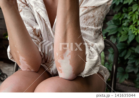 Close up of female legs and arms with vitiligo, unique pigmentation, autoimmune skin condition, copy space 141635044