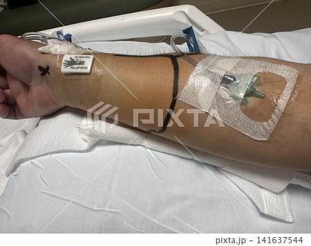 カテーテル治療後の手首の腫れと血腫　術後回復中の橈骨動脈穿刺部 141637544