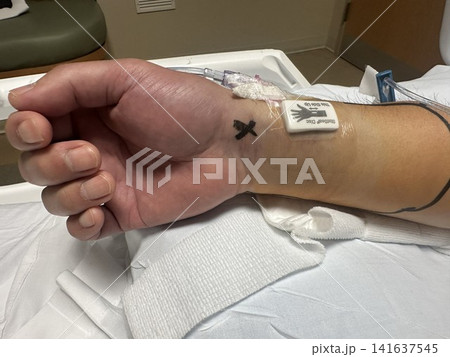 カテーテル治療後の内出血と腫れが見られる手首 術後回復の経過 カテーテル治療後の内出血と腫れが見られる手首 術後回復の経過 141637545