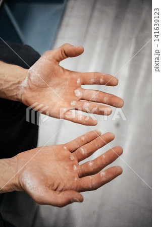 Chalk Covered Male Climber Hands After Hard Route: Close Up Of Worn Fingers And Taped Skin Chalk Covered Male Climber Hands After Hard Route: Close Up Of Worn Fingers And Taped Skin 141639123