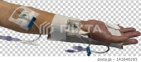 Patient's arm during catheter treatment (transparent PNG) IV line/medical procedure material Patient's arm during catheter treatment (transparent PNG) IV line/medical procedure material 141640285