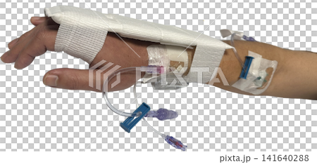 Intravenous drip route and fixation on the back of the hand during catheter treatment (transparent background PNG) Intravenous drip route and fixation on the back of the hand during catheter treatment (transparent background PNG) 141640288