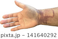 カテーテル治療後の手に生じた内出血と血腫（背景透過PNG） 141640292