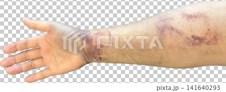 Internal bleeding and subcutaneous hematoma spreading from the wrist to the forearm after catheter treatment (transparent background PNG) Internal bleeding and subcutaneous hematoma spreading from the wrist to the forearm after catheter treatment (transparent background PNG) 141640293