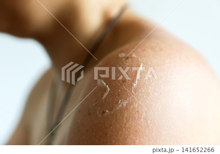 Close-up of peeling skin on a person's sunburned shoulder, dermatology and summer skincare concept Close-up of peeling skin on a person's sunburned shoulder, dermatology and summer skincare concept 141652266