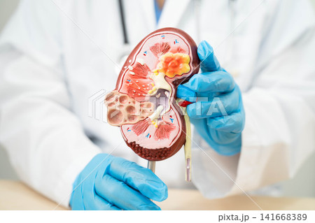 Chronic kidney disease, doctor with model for treatment urinary system, urology, Estimated glomerular filtration rate eGFR. 141668389